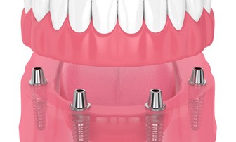 illustration of implant dentures for cost of dentures in Greensboro