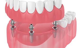 digital diagram of implant dentures in Greensboro