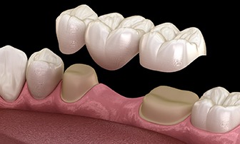 Digital illustration of dental bridge