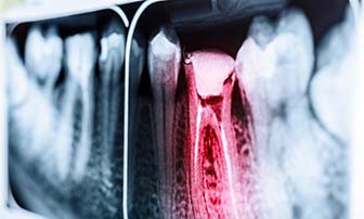 Highlighted X-ray of toothache in Greensboro