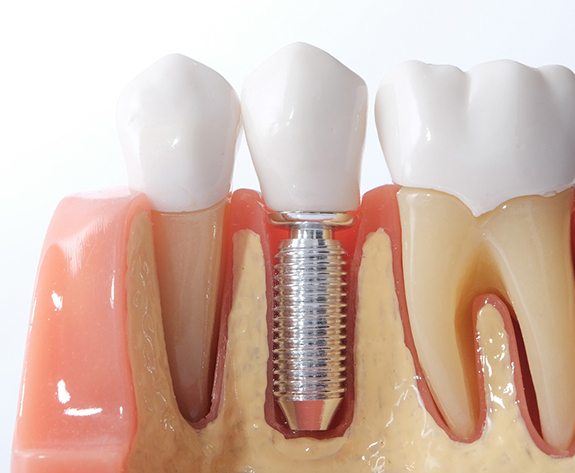 model of how dental implants in Greensboro work