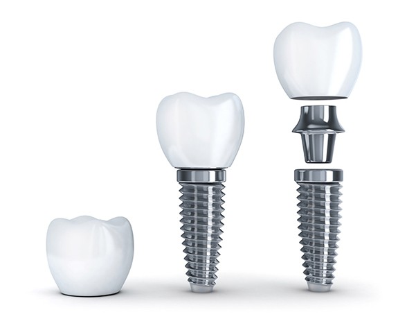dental crown, abutment, and implant post