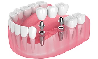 dental bridge being supported by two dental implants 