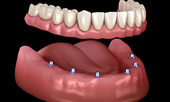 implant denture being placed