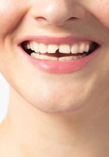 Don’t let painful cavities or broken teeth dampen your smile near Lake Oconee