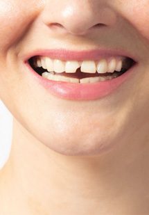 patient smiling in dental mirror 