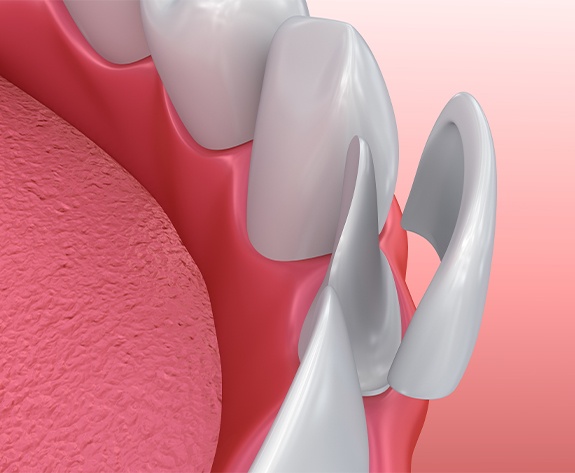 Animated smile during porcelain veneer placement