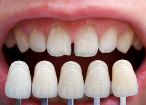 Porcelain veneers vs. imperfect teeth