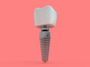 Dental implant